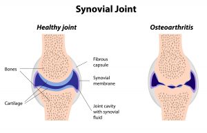 knee osteoarthritis prolotherapy